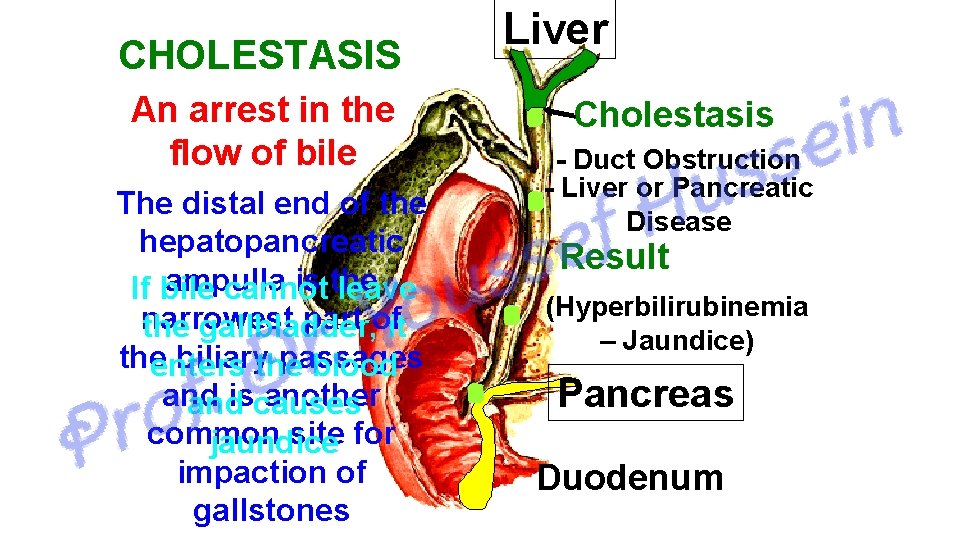 CHOLESTASIS An arrest in the flow of bile The distal end of the hepatopancreatic