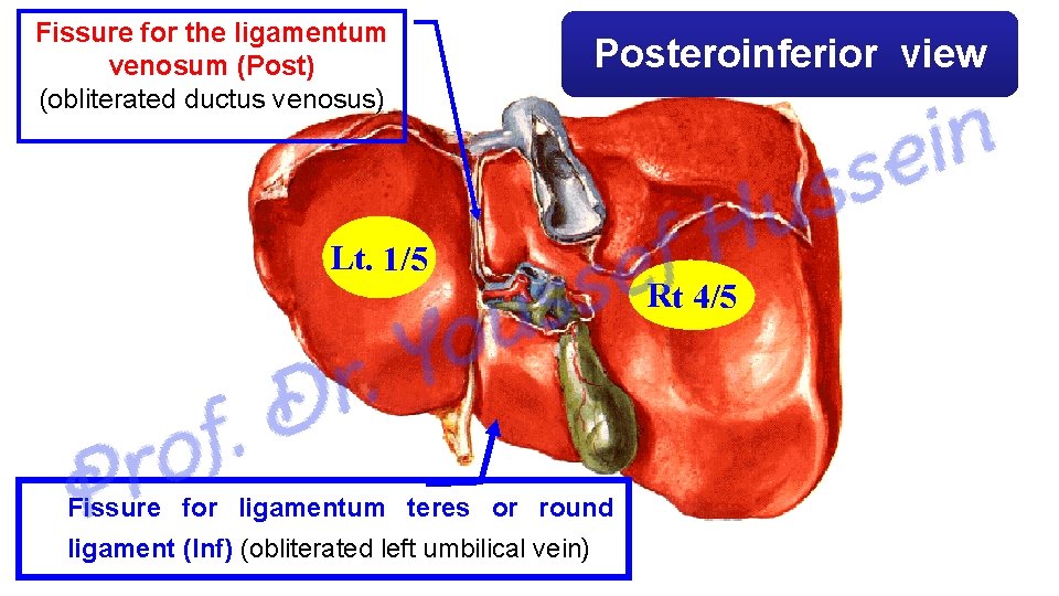Fissure for the ligamentum venosum (Post) (obliterated ductus venosus) Posteroinferior view Lt. 1/5 Fissure