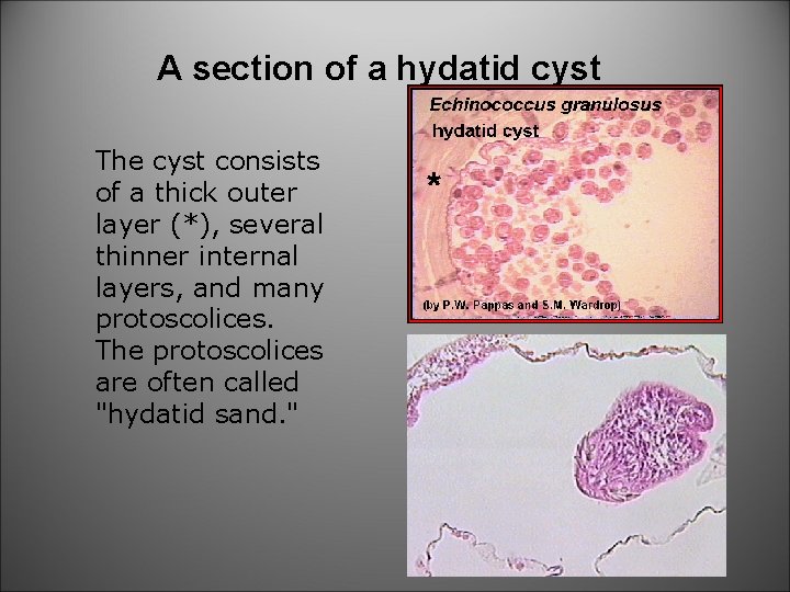A section of a hydatid cyst The cyst consists of a thick outer layer