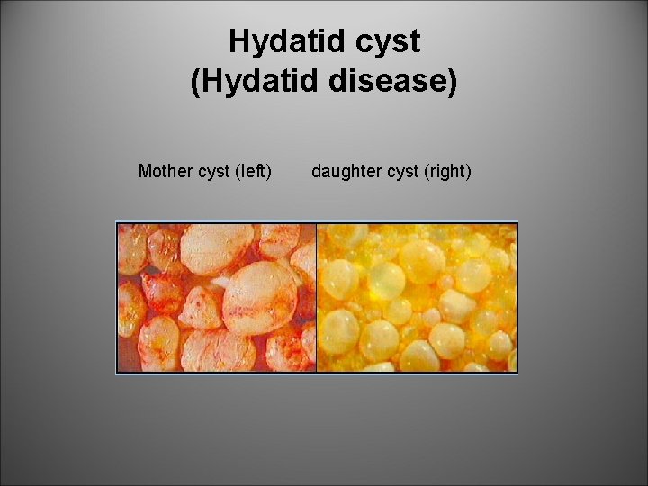 Hydatid cyst (Hydatid disease) Mother cyst (left) daughter cyst (right) 