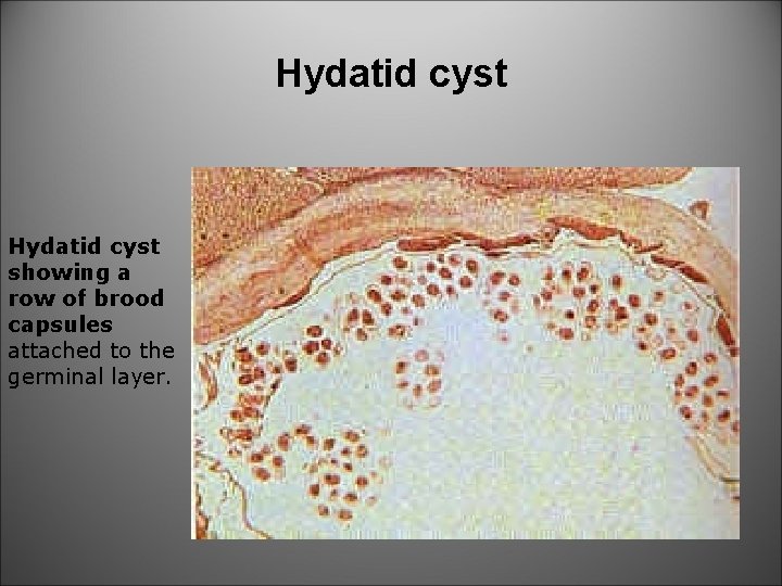 Hydatid cyst showing a row of brood capsules attached to the germinal layer. 