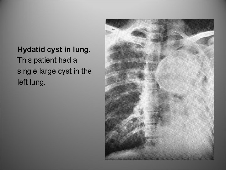 Hydatid cyst in lung. This patient had a single large cyst in the left