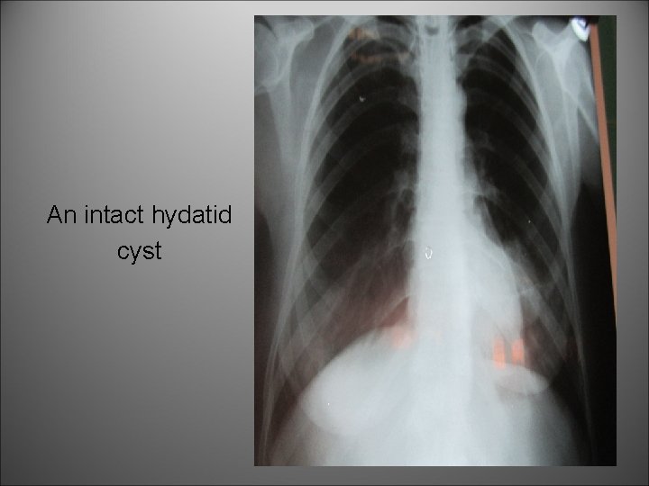 An intact hydatid cyst 