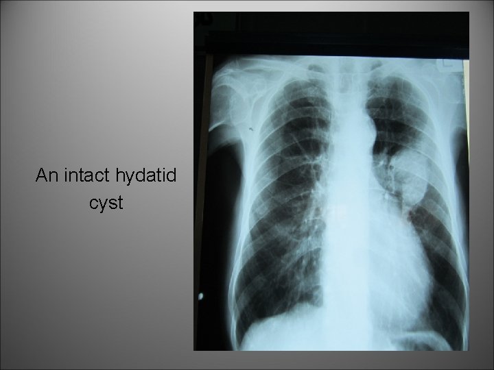 An intact hydatid cyst 