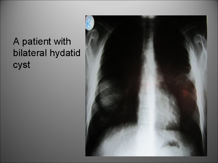 A patient with bilateral hydatid cyst 