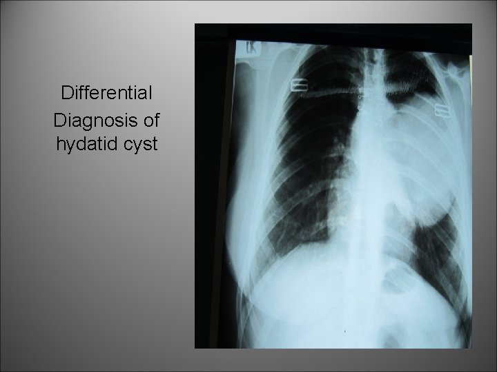 Differential Diagnosis of hydatid cyst 