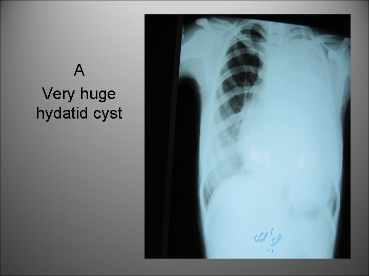 A Very huge hydatid cyst 