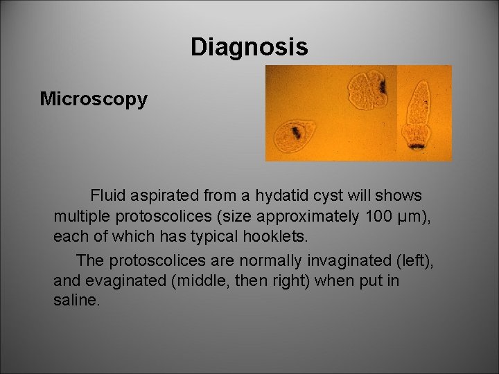 Diagnosis Microscopy Fluid aspirated from a hydatid cyst will shows multiple protoscolices (size approximately