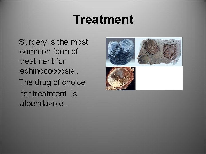 Treatment Surgery is the most common form of treatment for echinococcosis. The drug of