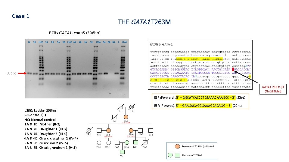 Case 1 THE GATA 1 T 263 M PCRs GATA 1, exon 5 (306