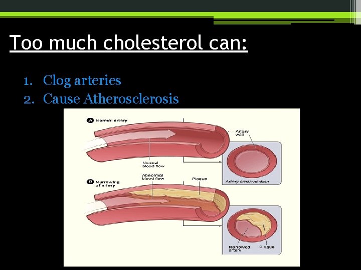 Too much cholesterol can: 1. Clog arteries 2. Cause Atherosclerosis 