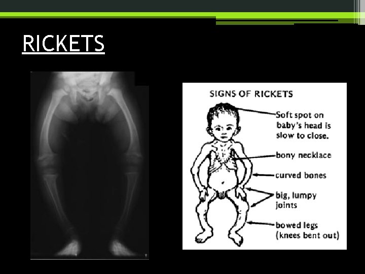 RICKETS 