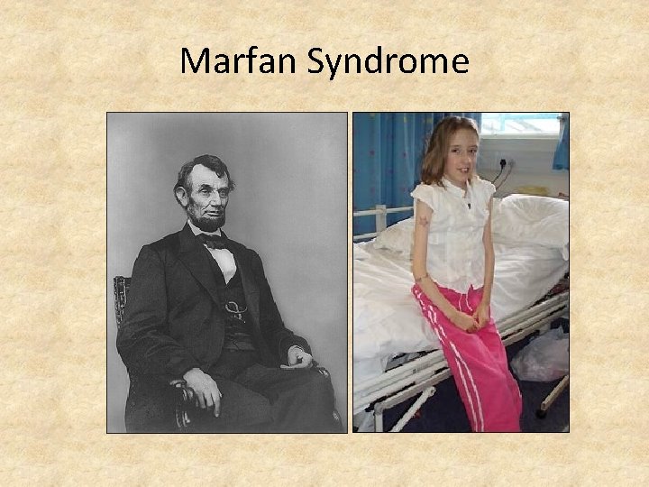 Marfan Syndrome 