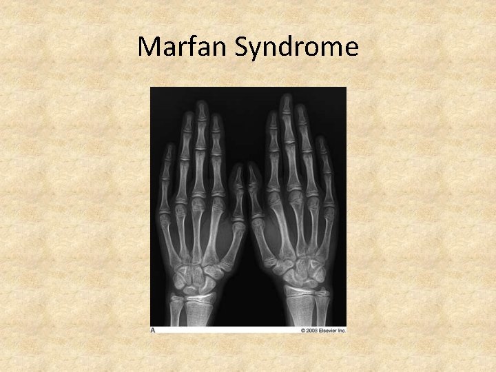 Marfan Syndrome 