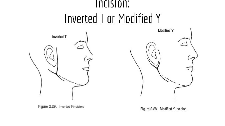 Incision: Inverted T or Modified Y 