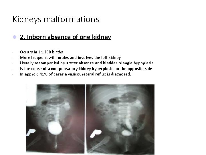 Kidneys malformations 2. Inborn absence of one kidney - Occurs in 1: 1300 births