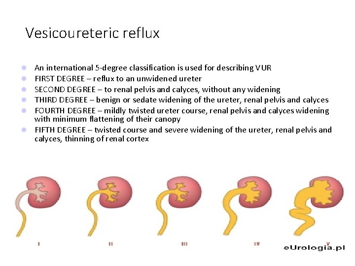 Vesicoureteric reflux An international 5 -degree classification is used for describing VUR FIRST DEGREE