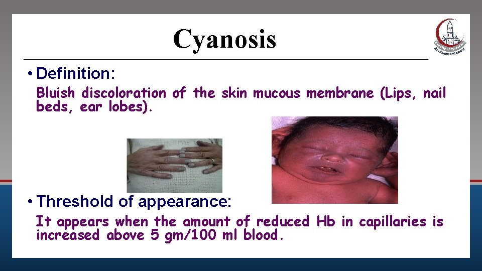 Cyanosis • Definition: Bluish discoloration of the skin mucous membrane (Lips, nail beds, ear