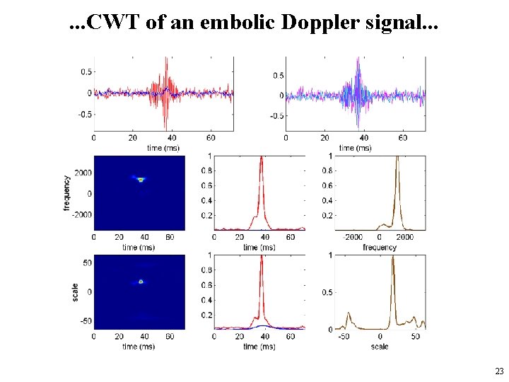 . . . CWT of an embolic Doppler signal. . . 23 