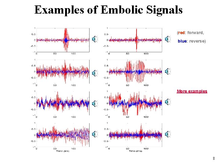 Examples of Embolic Signals (red: forward, blue: reverse) More examples 8 