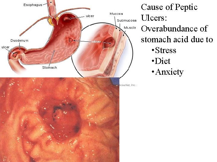 Cause of Peptic Ulcers: Overabundance of stomach acid due to • Stress • Diet