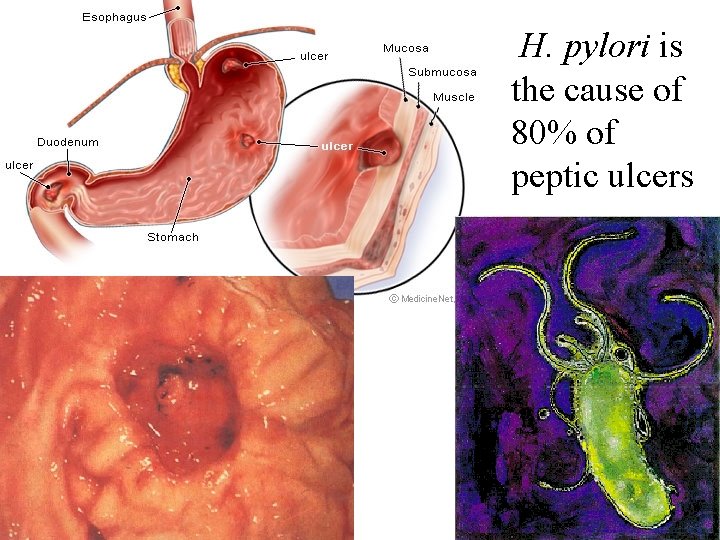 H. pylori is the cause of 80% of peptic ulcers 