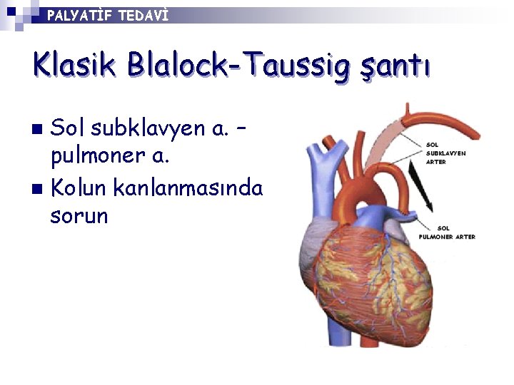 PALYATİF TEDAVİ Klasik Blalock-Taussig şantı Sol subklavyen a. – pulmoner a. n Kolun kanlanmasında