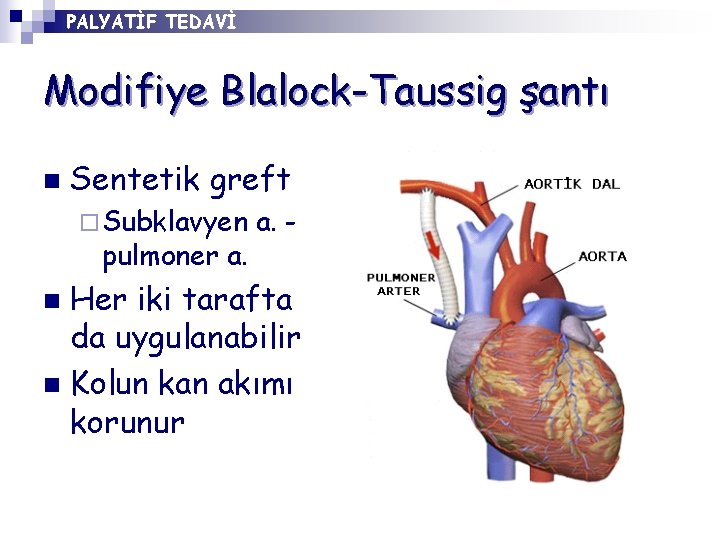 PALYATİF TEDAVİ Modifiye Blalock-Taussig şantı n Sentetik greft ¨ Subklavyen pulmoner a. - Her