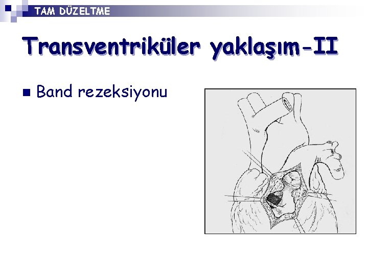 TAM DÜZELTME Transventriküler yaklaşım-II n Band rezeksiyonu 