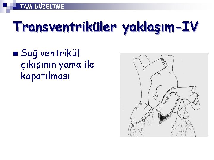 TAM DÜZELTME Transventriküler yaklaşım-IV n Sağ ventrikül çıkışının yama ile kapatılması 