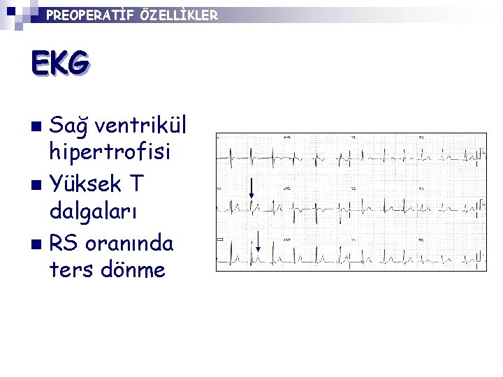 PREOPERATİF ÖZELLİKLER EKG Sağ ventrikül hipertrofisi n Yüksek T dalgaları n RS oranında ters