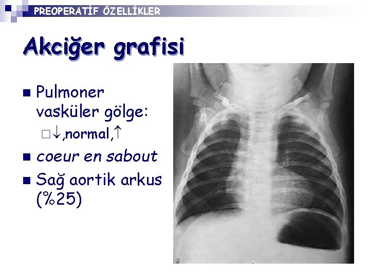 PREOPERATİF ÖZELLİKLER Akciğer grafisi n Pulmoner vasküler gölge: ¨ , normal, coeur en sabout