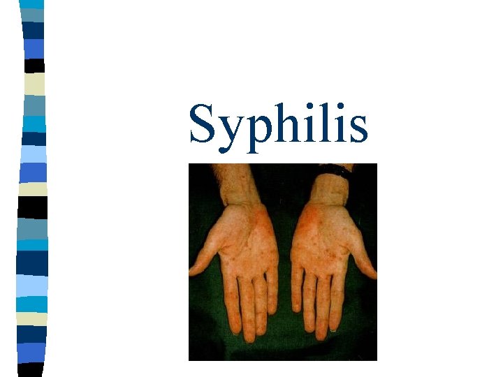 Syphilis Syphilis