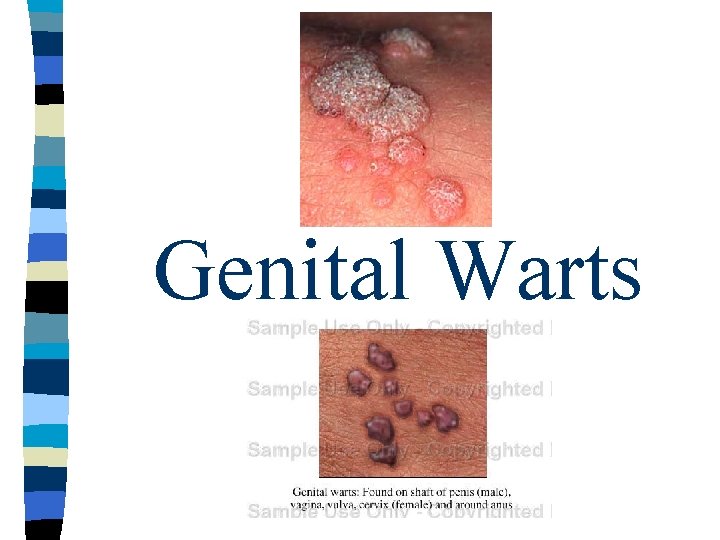 Genital Warts Genital Warts