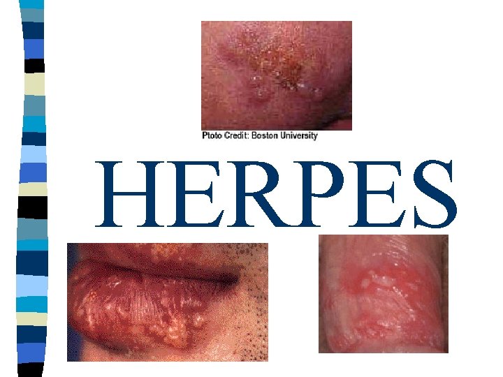 HERPES HERPES