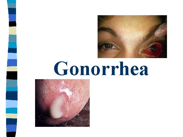 Gonorrhea Gonorrhea