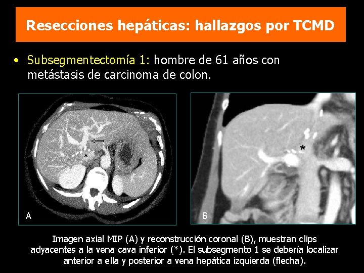 Resecciones hepáticas: hallazgos por TCMD • Subsegmentectomía 1: hombre de 61 años con metástasis