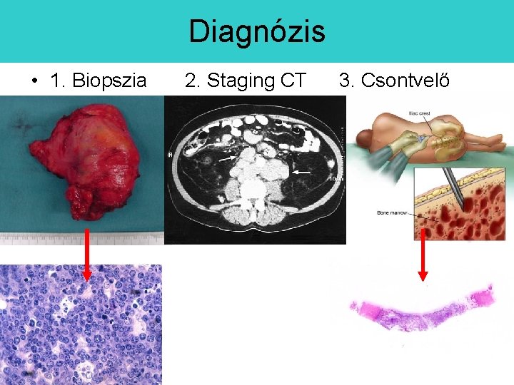 Diagnózis • 1. Biopszia 2. Staging CT 3. Csontvelő 