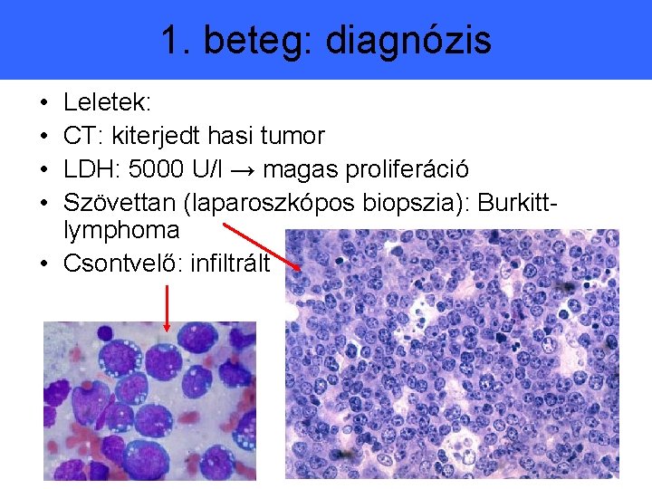 1. beteg: diagnózis • • Leletek: CT: kiterjedt hasi tumor LDH: 5000 U/l →