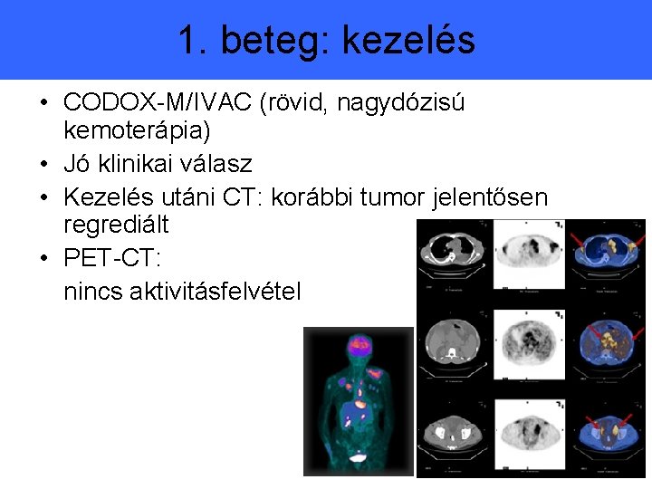 1. beteg: kezelés • CODOX-M/IVAC (rövid, nagydózisú kemoterápia) • Jó klinikai válasz • Kezelés