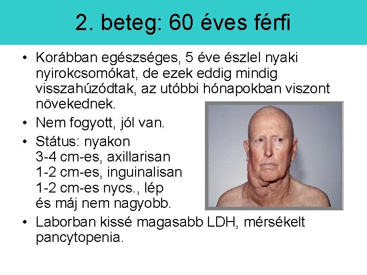 2. beteg: 60 éves férfi • Korábban egészséges, 5 éve észlel nyaki nyirokcsomókat, de