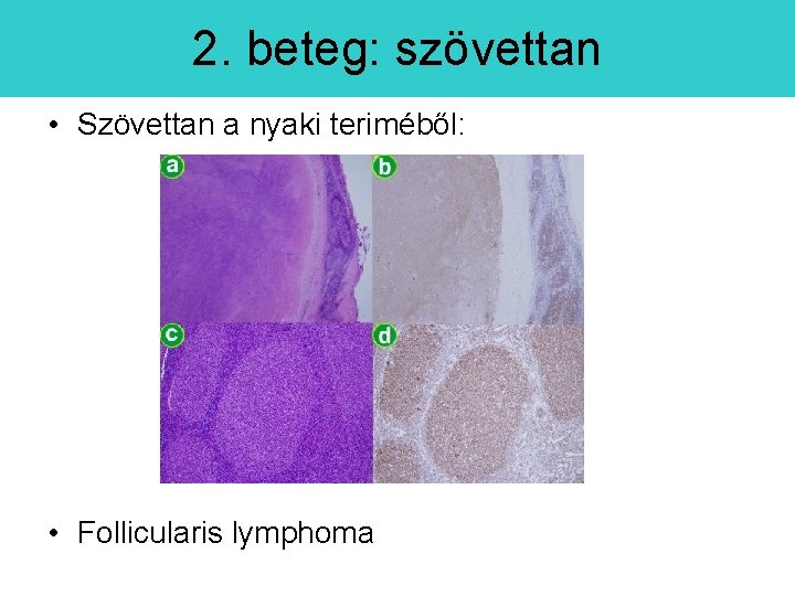 2. beteg: szövettan • Szövettan a nyaki teriméből: • Follicularis lymphoma 