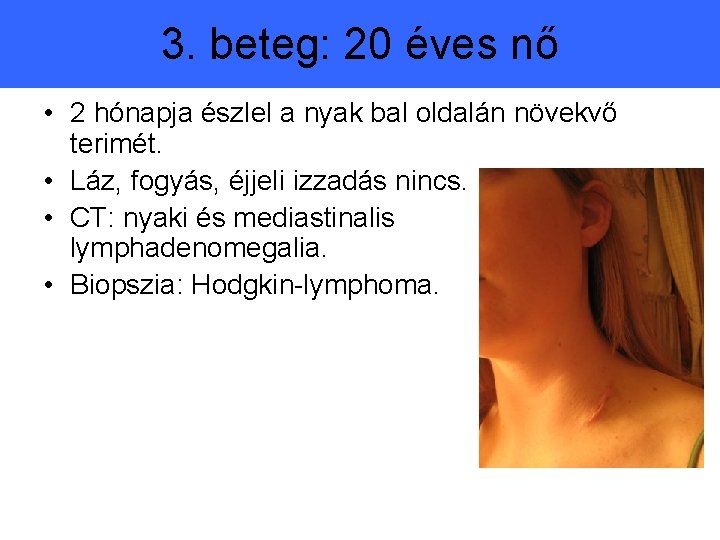 3. beteg: 20 éves nő • 2 hónapja észlel a nyak bal oldalán növekvő