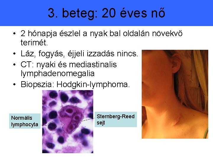 3. beteg: 20 éves nő • 2 hónapja észlel a nyak bal oldalán növekvő