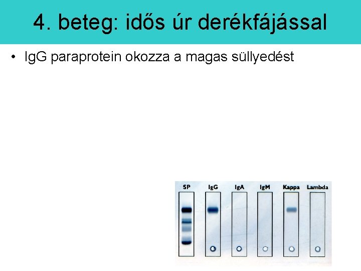 4. beteg: idős úr derékfájással • Ig. G paraprotein okozza a magas süllyedést 