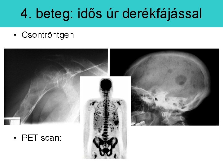 4. beteg: idős úr derékfájással • Csontröntgen • PET scan: 