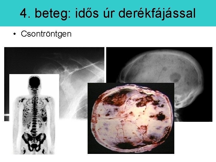 4. beteg: idős úr derékfájással • Csontröntgen • PET scan: 