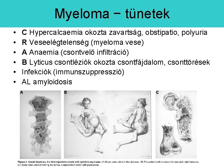 Myeloma − tünetek • • • C Hypercalcaemia okozta zavartság, obstipatio, polyuria R Veseelégtelenség