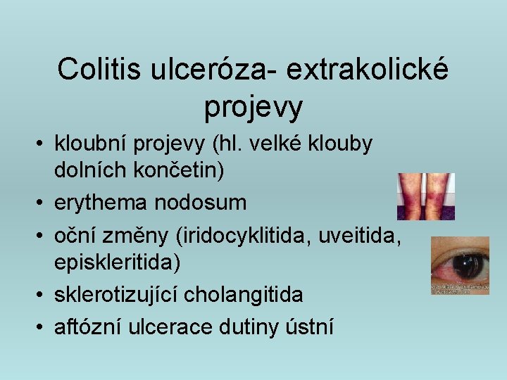 Colitis ulceróza- extrakolické projevy • kloubní projevy (hl. velké klouby dolních končetin) • erythema