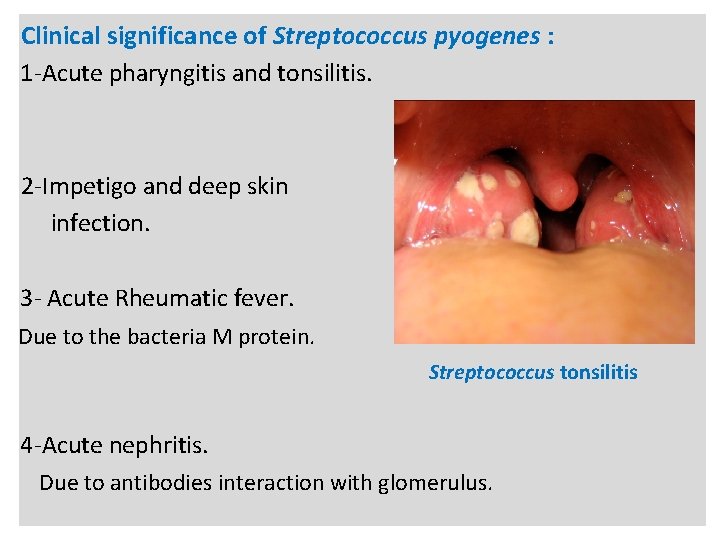 n Clinical significance of Streptococcus pyogenes : 1 -Acute pharyngitis and tonsilitis. 2 -Impetigo